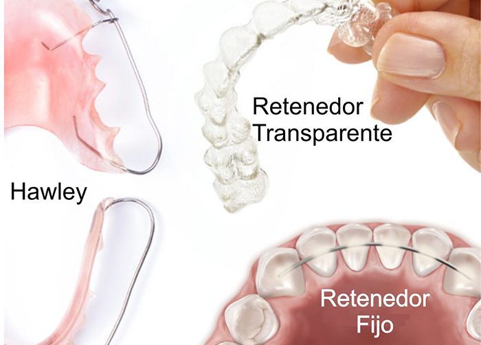 Limpieza y mantenimiento de Férulas (Invisalign, retenedores ortodoncia,  Férulas de descarga) 