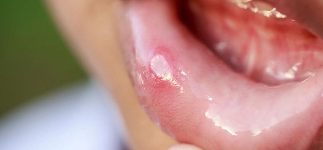 Descubre cómo actuar si tienes llagas en la boca