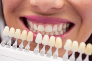 Disfruta de unos dientes más blancos con el blanqueamiento dental en Kaizen Marbella