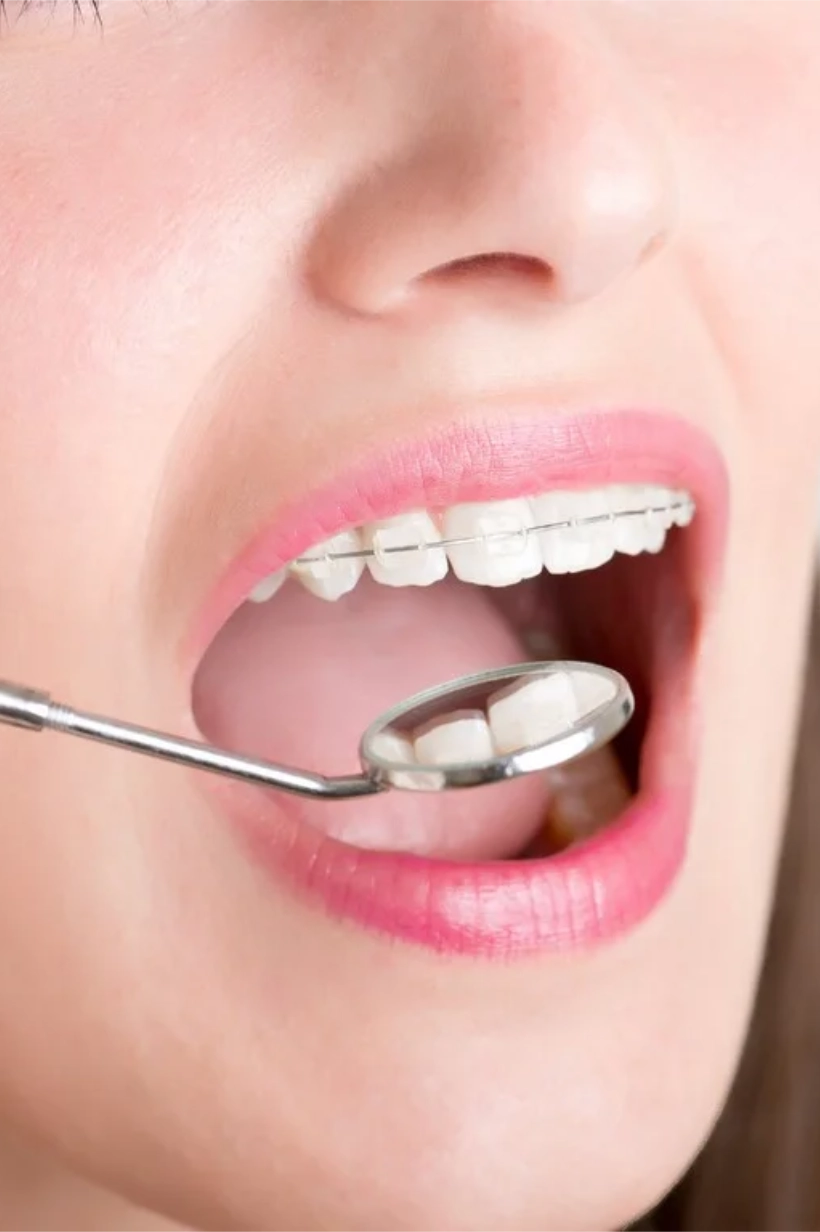Fotografía de la boca de una mujer con un bracket estético y un espejo de dentista