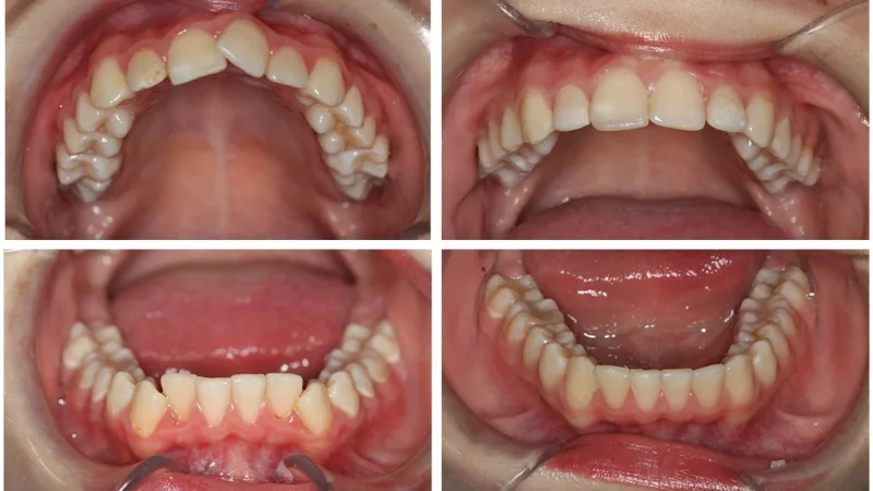Fotografía de detalle de la boca de Elisabetta, paciente de Clínica Kaizen