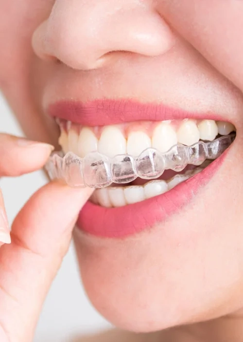 Fotografía de la dentadura de una mujer con alineadores transparentes Invisalign