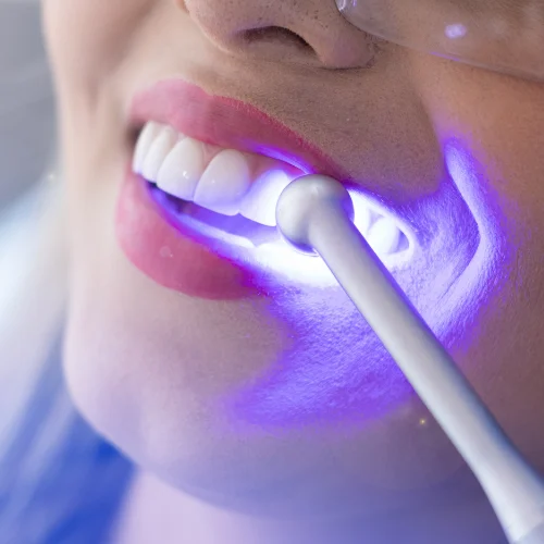 Fotografía de una mujer a la que se le aplica un tratamiento de blanqueamiento dental