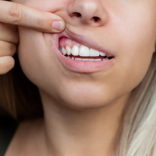 Fotografía de una mujer mostrando sus encías con un dedo