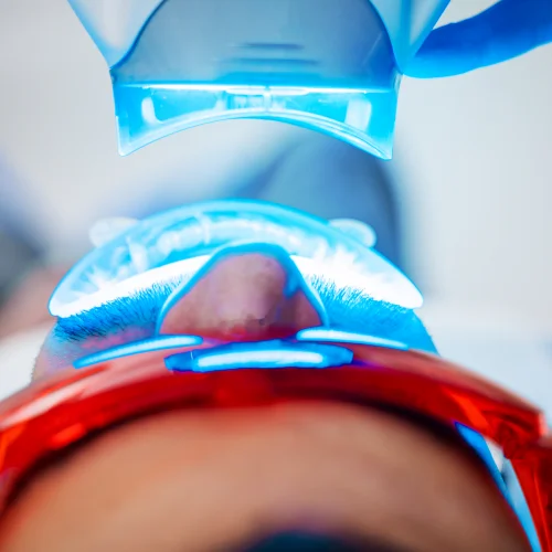 Fotografía de un hombre recibiendo un tratamiento de blanqueamiento dental láser